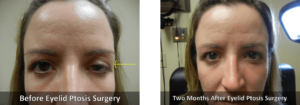 Eyelid Ptosis Before and After