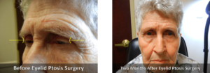 Eyelid Ptosis Before and After