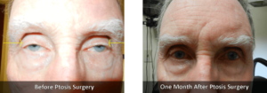 Eyelid Ptosis Before and After