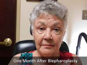 One Month After Blepharoplasty