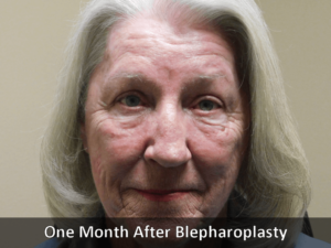 After Blepharoplasty