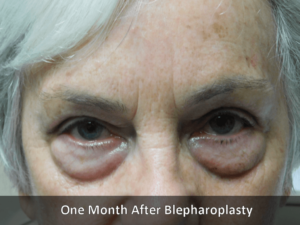 After Blepharoplasty