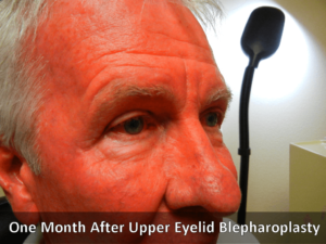 after blepharoplasty