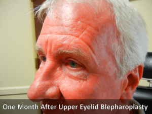 after blepharoplasty