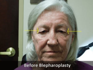 Before Blepharoplasty
