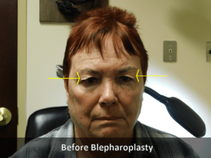 Before Blepharoplsty Front