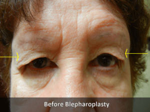Before Blepharoplasty