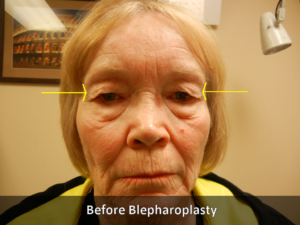 Before Belpharoplasty