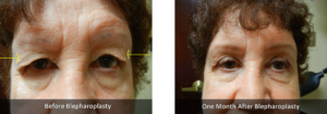 Blepharoplasty Before and After