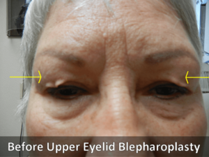 Blepharoplasty Pre Surgery