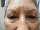 BEFORE Upper Eyelid Blepharoplasty