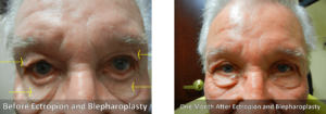 Ectropion Surgery Before and After