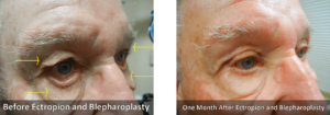 Ectropion Surgery Before and After