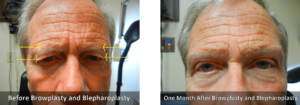 Eyebrow ptosis Before and After