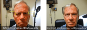 Eyebrow ptosis Before and After