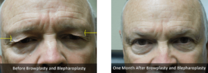Eyebrow ptosis Before and After