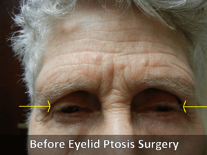 Ptosis Surgery Before