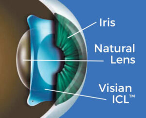 ICL 